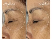 ヴィヴァン(Vivant)/シワケア★プラズマフェイシャル