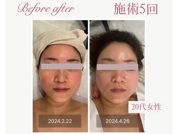 パルタージュ 三宮(Partage)/透明感アップフェイシャル