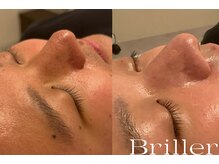 ブリエ(Briller)/毛穴洗浄＋鎮静パック