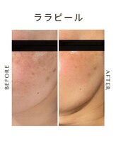 ツヤハダコガオ 千葉店/before⇒after　【ララピール】