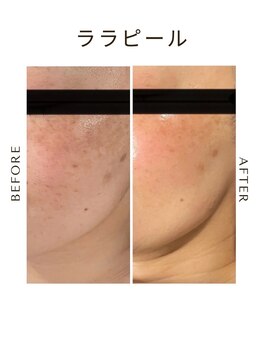 ツヤハダコガオ 千葉店/before⇒after 【ララピール】