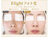 【肌トラブル改善にオススメ!】ELIGHTフォト光★【新規6,000円】