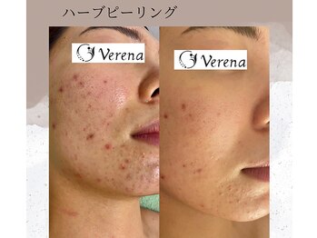 ベルーテ 田町三田(Bellute)/繰り返す肌荒れにアプローチ★