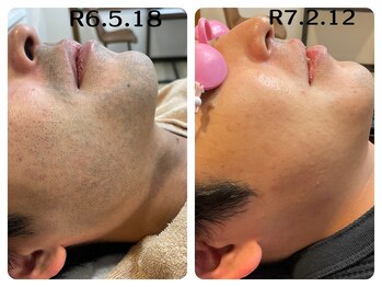 フィズ 五日市彩が丘店(FIS)/☆美肌脱毛☆都度払い