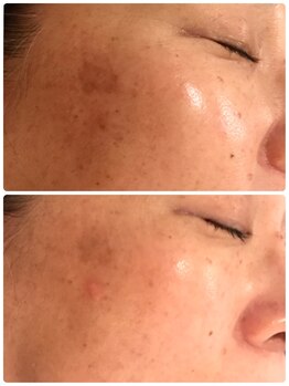 リュウ鍼灸院 サロン ド リュウ(Salon de Ryu)/シミケアでの改善例