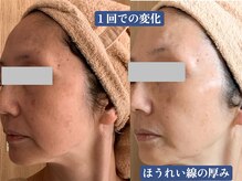 エメ 心斎橋(Aimer)の雰囲気（ハーブピーリング×毛穴洗浄、たるみケア、毛穴の悩みにも◎）