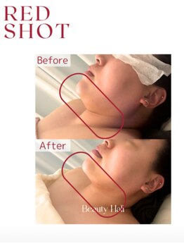 ビオトナス(Facial Esthe)/レモンの進化版!レッドショット