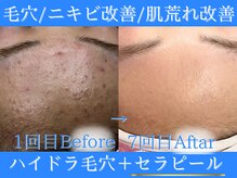 Cスキンケアクリニック 麻布店/ハイドラ毛穴＋セラピール