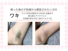 アルゴ 熊本宇土店(ALGO)/【脇】不快感や痒みからの解放☆