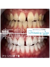 ホワイトニングサロン 福岡天神店/ホワイトニング