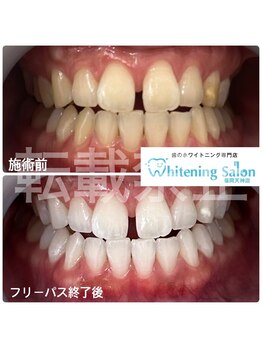 ホワイトニングサロン 福岡天神店/ホワイトニング