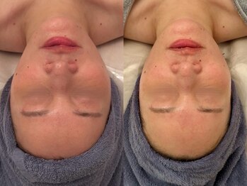 ポーデベロア(Peau des velours)/マッサージ/ホワイトタンニング