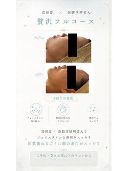 エフリア 大垣(F.lia)/別人！顎下の脂肪が消えた！！