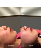 プライミー(PRIMY)/切らない「人中短縮」