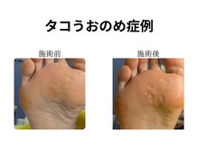 ドクターネイル爪革命 和歌山/胼胝魚の目