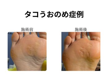 ドクターネイル爪革命 和歌山/胼胝魚の目