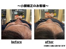 トータルビューティーみつとも/小顔矯正/インディバ/EMS