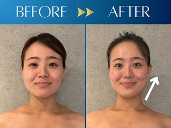 シンク 表参道(CINQ)/美容鍼灸60分1回の変化