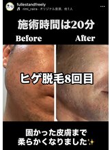 フーレスト アンド フリーリー(Fullest&Freely)/ヒゲ脱毛の効果