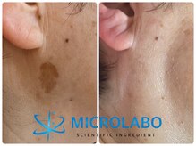 リュウ鍼灸院 サロン ド リュウ(Salon de Ryu)/マイクロラボピーリング