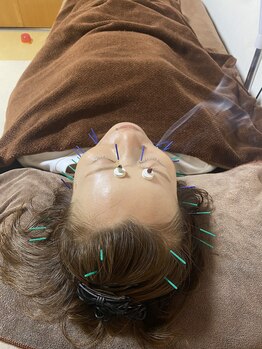 アリッシュ(ARiSH)/鍼の様子