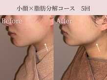 ミア(miiia)/小顔×脂肪分解コース　5回