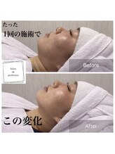 サロン ド パーフェクション(Salon de Perfection)/小顔リフト