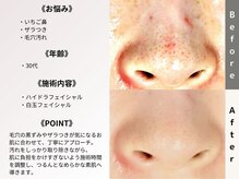 ルディラ医療提携エステ 立川店 毛穴/小顔/ニキビ・シミ・美白・シワ・たるみケア/ハイドラフェイシャル