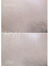 アイリーユー(Airy U)/シェービングのビフォーアフター