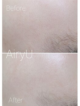 アイリーユー(Airy U)/シェービングのビフォーアフター