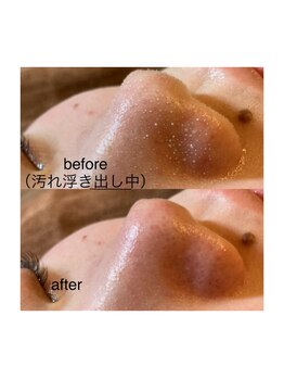 ツルル 岡崎店(TSURURU)/【毛穴水素洗浄】