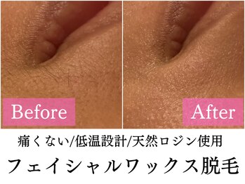 マイン(mine)/フェイシャルワックス脱毛