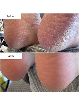 ケアプラス(care plus)/足裏角質ケア