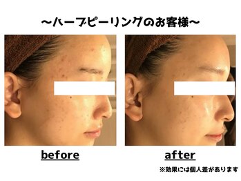 トータルビューティーみつとも/ハーブピーリング