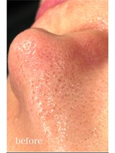 ドクターエイチ 四ツ橋堀江店(Doctor.H)/ハイドロ＋無針水光注入