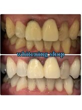 ホワイトニングショップ 大宮店/差し歯や詰め物がある方にも♪