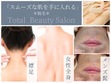 スムース(smooth)/【THR方式の痛みの少ない脱毛】