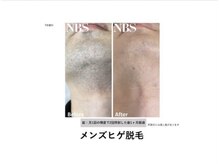 バーバーアミティプールオム(BARBER amity POUR HOMME)の雰囲気（男性用機械で効果を実感！【メンズ脱毛/ヒゲ脱毛】）
