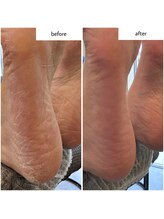 ケアプラス(care plus)/足裏角質ケア