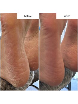 ケアプラス(care plus)/足裏角質ケア