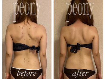 ピオニー(PEONY)/【痩身】二の腕/背中ハミ肉撃退