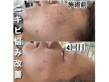 ハーブピーリングで本気の肌質改善