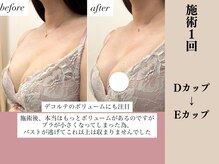 ソワ(soie)/施術後、上から見ても胸が違う！