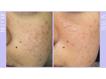 リラクゼーションサロン ラキ(laki)/スキンメイド/トロイアルケ