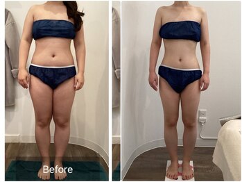 グランデヴァレ(Grande Vallee)/◆ビフォーアフター　20代