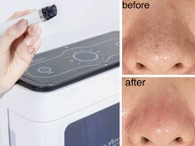 セルフラブ(Self love)/毛穴洗浄で顔の黒ずみスッキリ