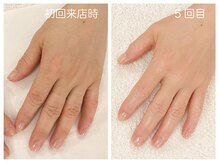 キレイテ 福岡天神店/30代/5回目【福岡ハンドケア】