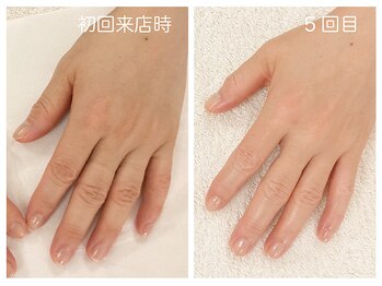 キレイテ 福岡天神店/30代/5回目【福岡ハンドケア】