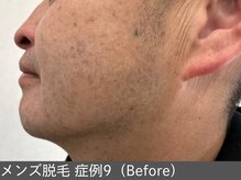 オアシスラグーン(OASIS LAGOON)/メンズ脱毛（症例9 before）