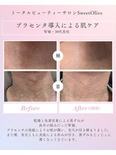 スウィートオリーブ 春日部(SweetOlive)/スーパー美容液プラセンタ